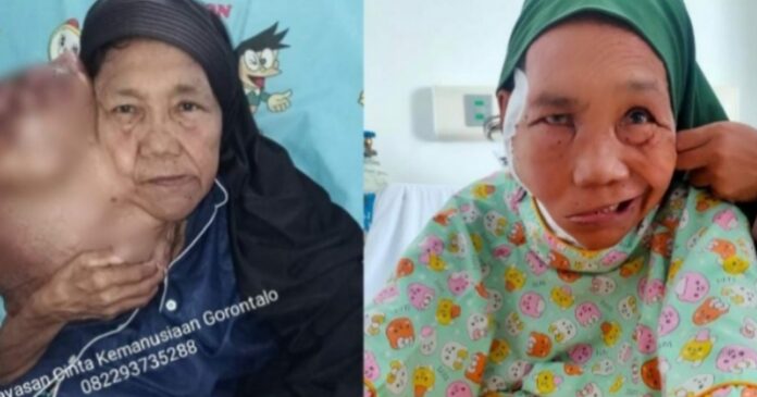 Pasca Operasi, Begini Keadaan Ibu Fatma Penderita Tumor di Pohuwato