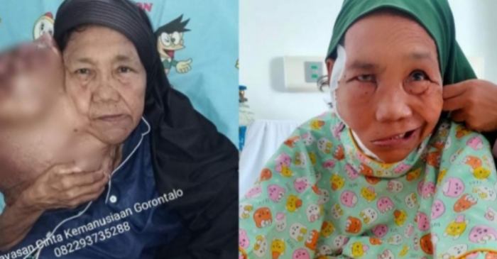 Pasca Operasi, Begini Keadaan Ibu Fatma Penderita Tumor di Pohuwato