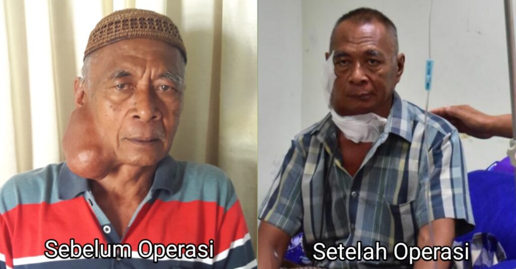 Bupati Pohuwato Tinjau Kondisi Warga Teratai Penderita Kanker Pipi Kanan